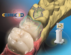 cerec-one-visit-crowns